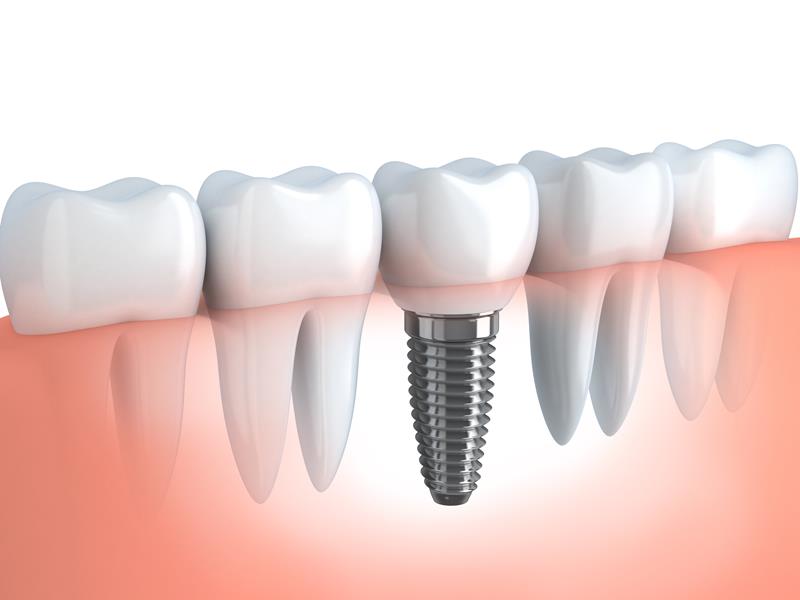 Dental Implants  Mt Vernon, NY 