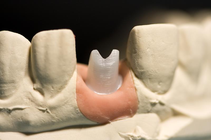Implant Restoration  Mt Vernon, NY 