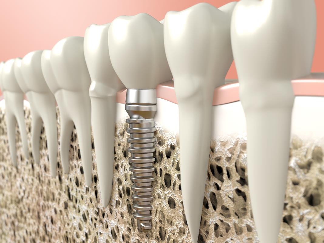 Dental Implants  Mt Vernon, NY 