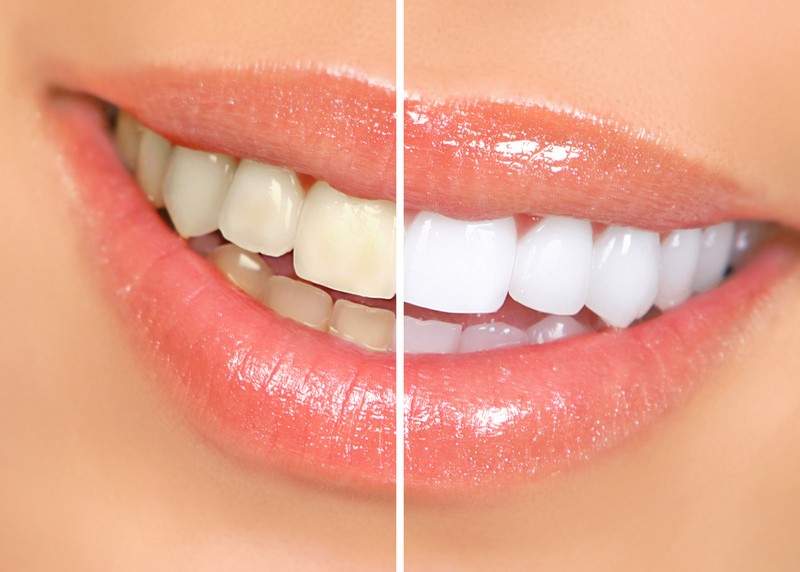 Teeth Whitening  Mt Vernon, NY 